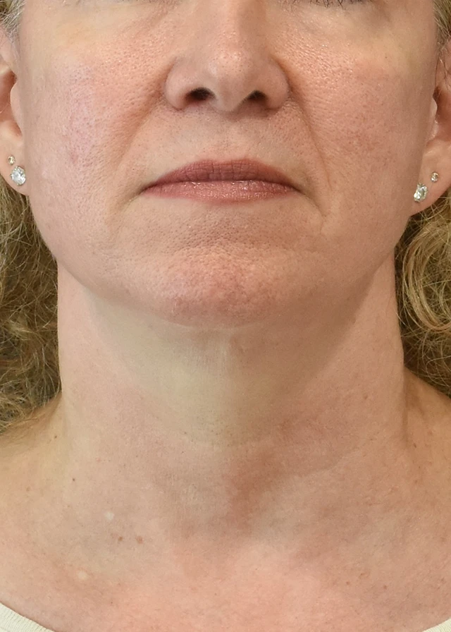 Deep Plane Facelift Patient 41 Set 1 After