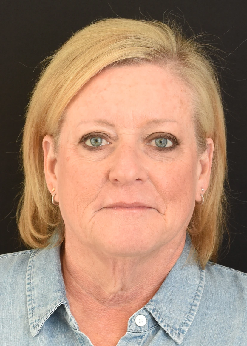 Deep Plane Facelift Patient 39 Set 1 Before