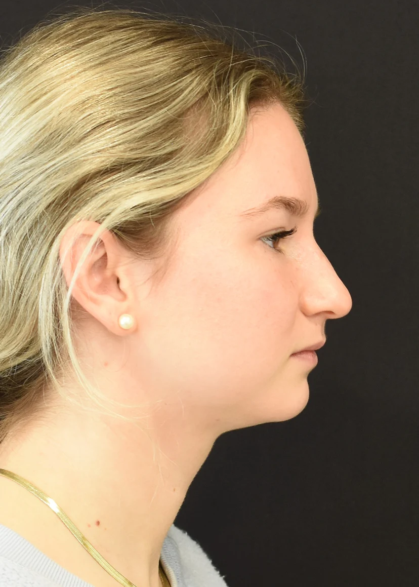 Rhinoplasty Patient 7 Set 3 Before