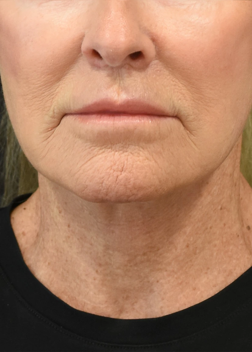 Neck Lift Patient 20 Set 1 After