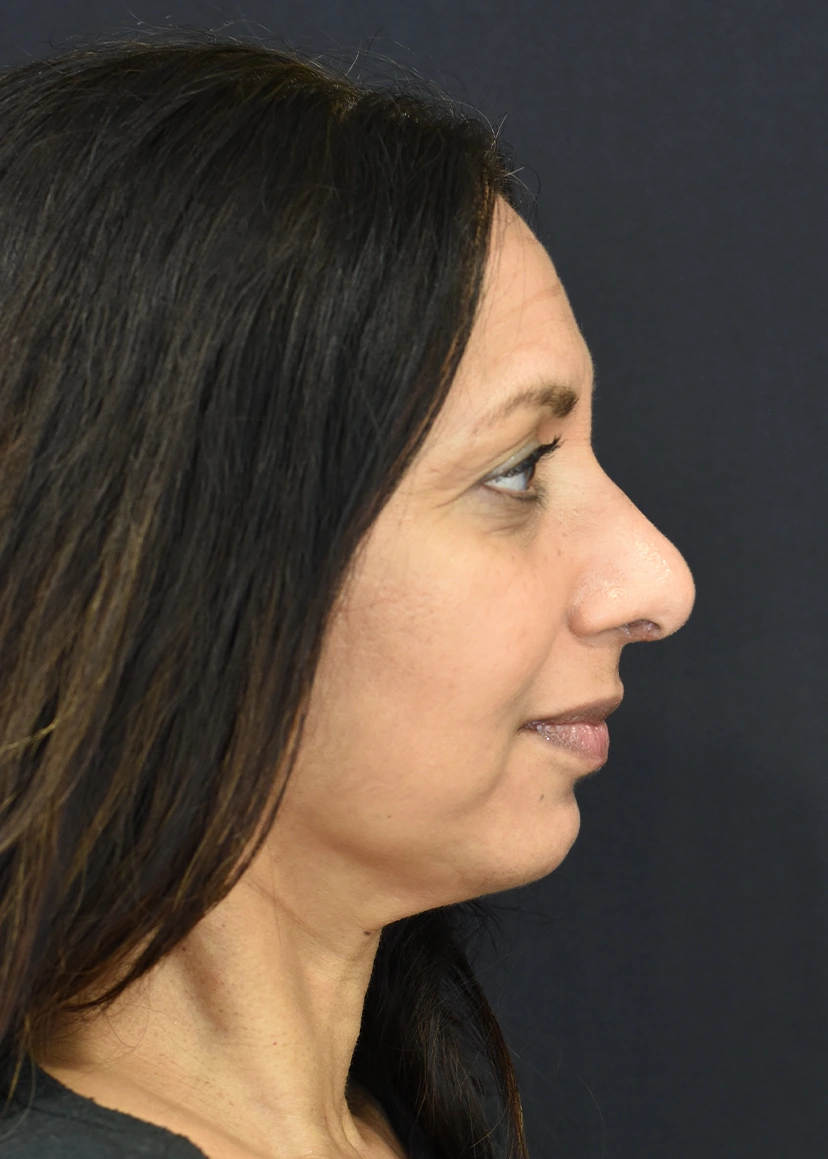Rhinoplasty Patient 10 Set 3 After