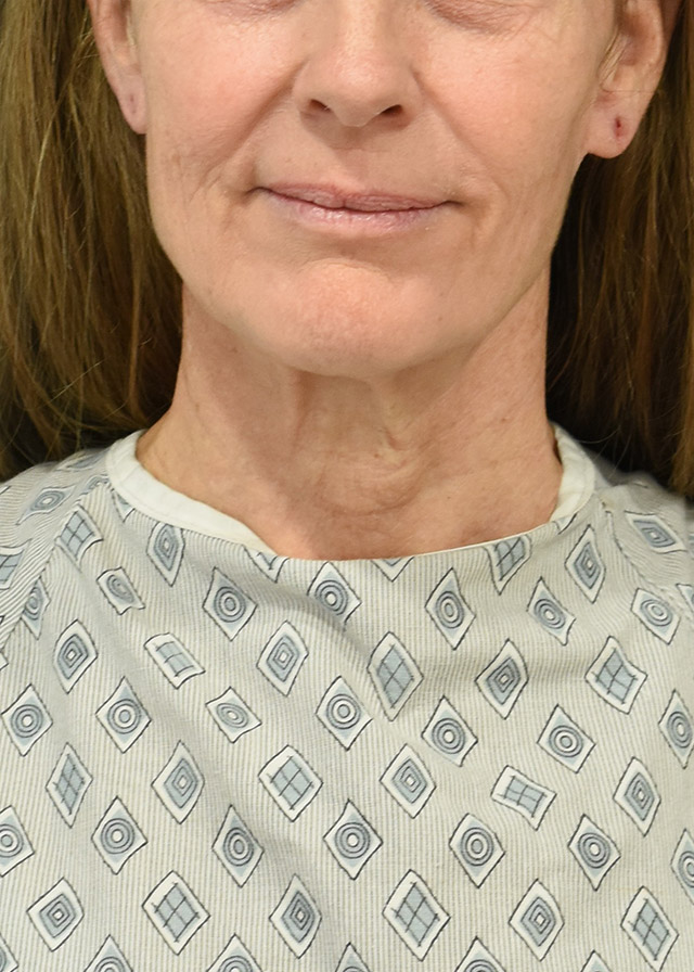 Neck Lift Patient 43 Set 1 Before