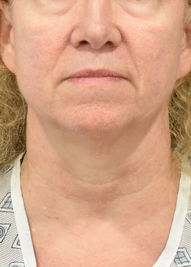 Deep Plane Facelift Patient 41 Set 1 Before